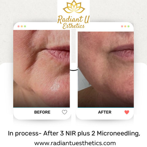 Nir Skin Tightening Treatment Radiant U Esthetics